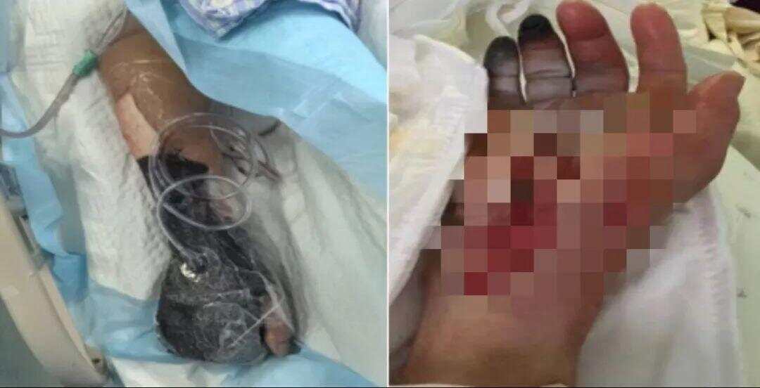 光脚踩到死鱼进ICU光脚踩到死鱼引发意外，紧急送入ICU抢救