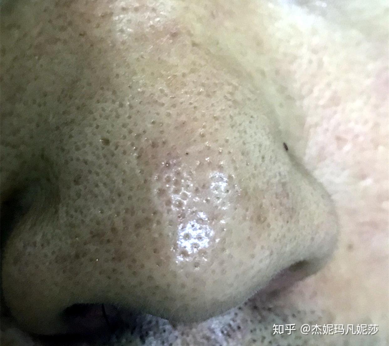 去黑头导致毛孔粗大去黑头导致毛孔粗大，原因、预防与解决方案